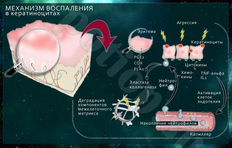 Механизм действия воспаления. Механизм воспаления. Механизм воспалительного процесса. Механизм воспаления картинка. Отек при воспалении механизм.